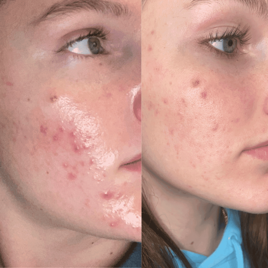 Close-up of a person's face before and after acne treatment, showing significant improvement.