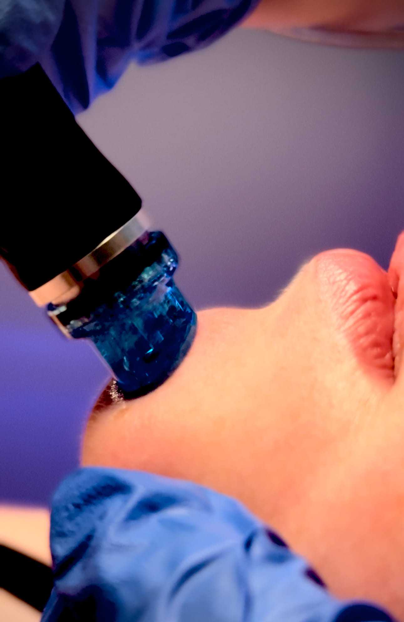 Skin treatment being performed with a handheld device on a person's cheek.